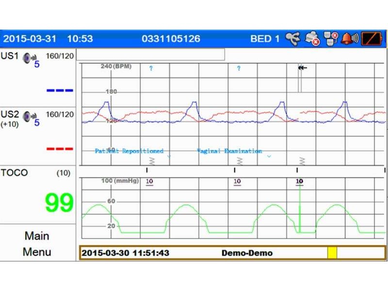 Monitor fetal Smart 3, Analiza NST (Non-Stress Test)