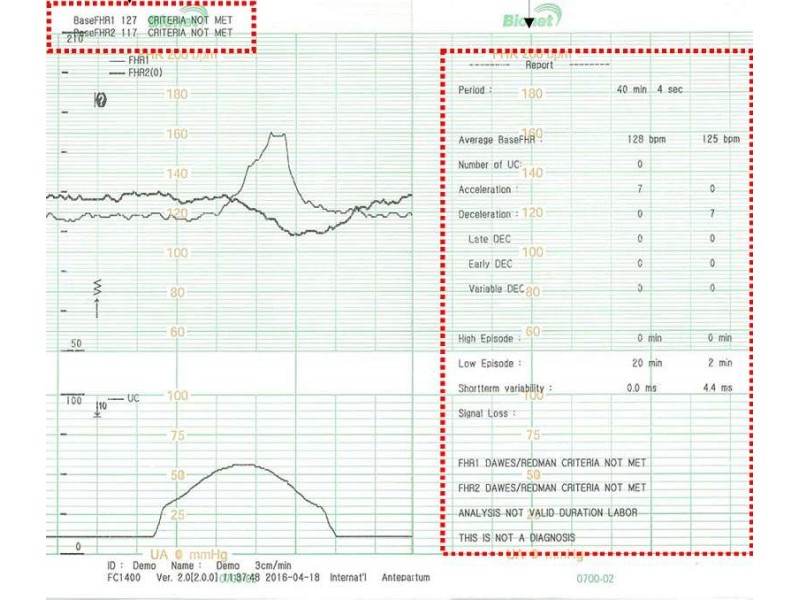 Monitor fetal Smart 3, Analiza NST (Non-Stress Test)
