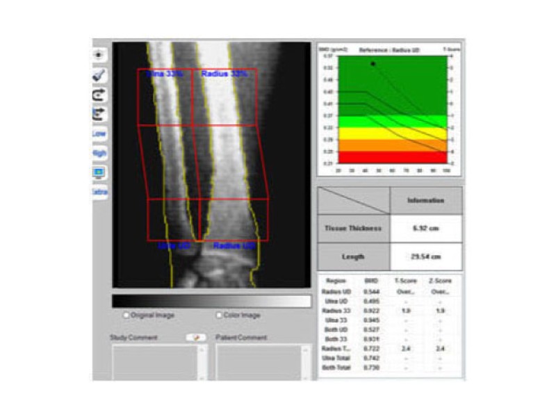Inus D Sistem Dexa Osteodensitometru cu raze X