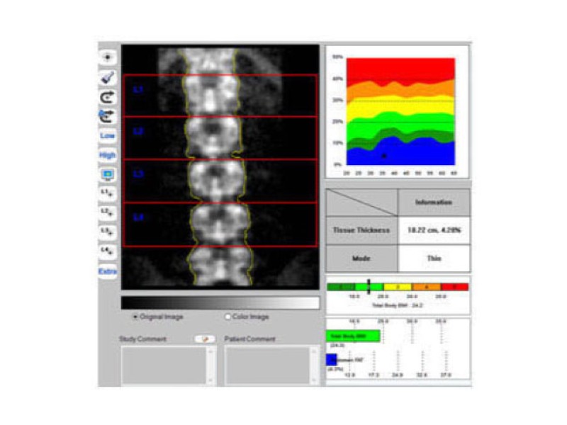 Inus D Sistem Dexa Osteodensitometru cu raze X